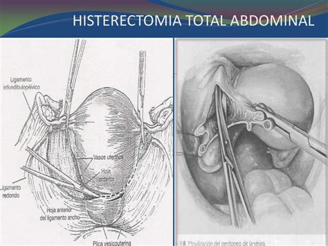 histerectomia abdominal - histerectomia abdominal